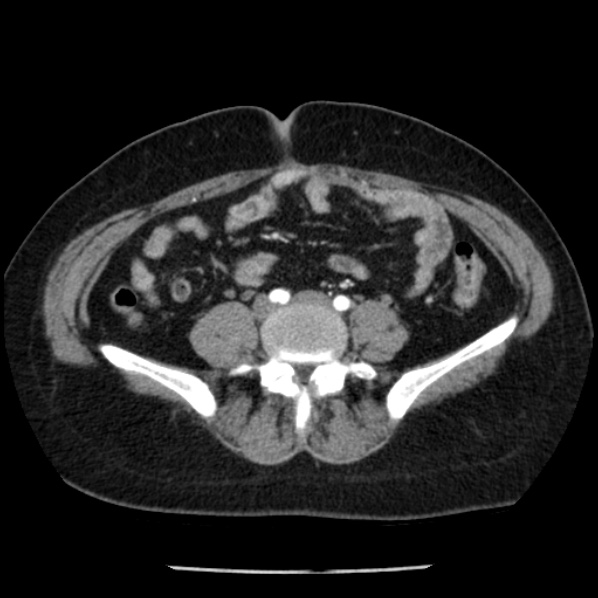 Adrenal myelolipoma (Radiopaedia 43401-46759 Axial C+ arterial phase 69).jpg