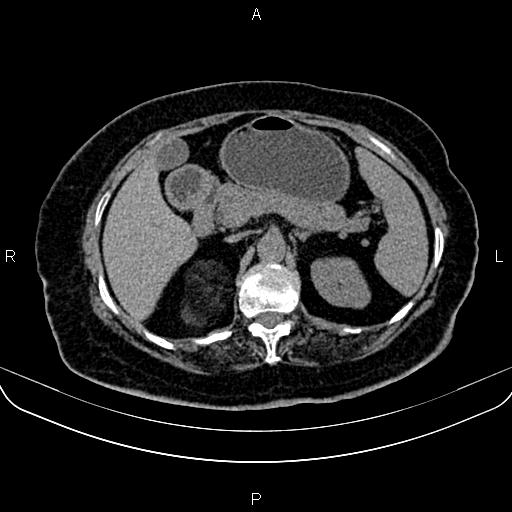 Adrenal myelolipoma (Radiopaedia 82742-96986 Axial non-contrast 48).jpg