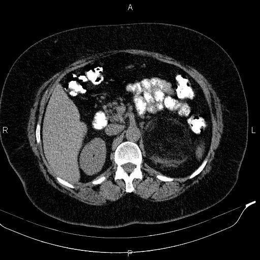 File:Adrenal myelolipoma (Radiopaedia 84319-99617 Axial With oral contrast 78).jpg