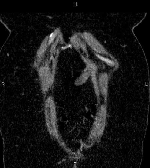 Adrenal myelolipoma (Radiopaedia 84319-99617 Coronal renal cortical phase 4).jpg