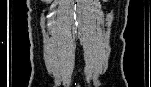 Adrenal myelolipoma (Radiopaedia 84321-99619 Coronal non-contrast 77).jpg