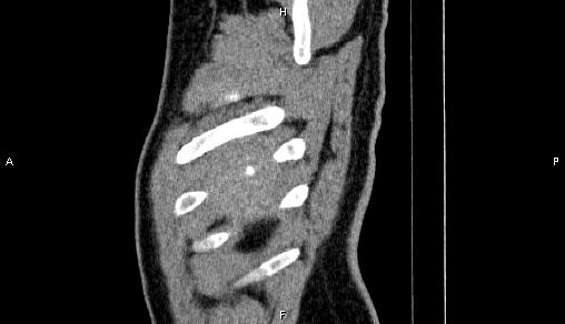 Adrenal myelolipoma (Radiopaedia 84321-99619 Sagittal non-contrast 6).jpg