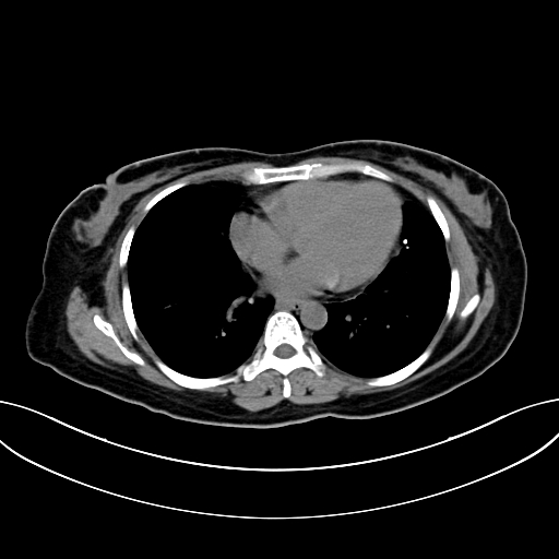 Adrenocortical carcinoma (Radiopaedia 87281-103569 Axial non-contrast 6).jpg
