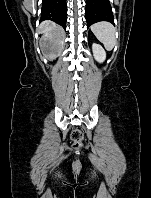 Adrenocortical carcinoma (Radiopaedia 87281-103569 Coronal C+ portal venous phase 123).jpg