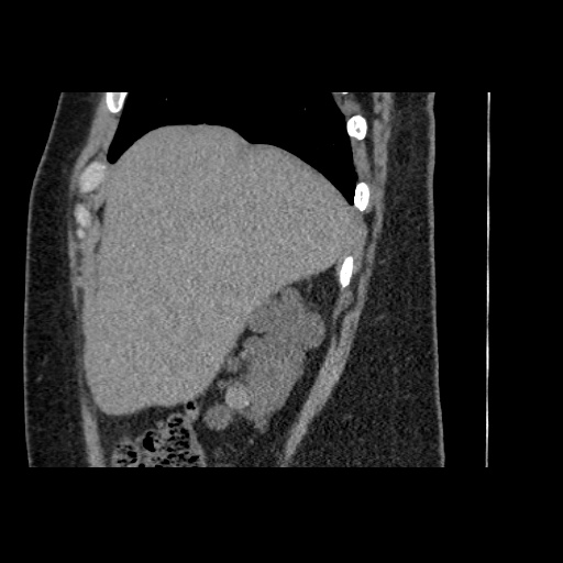 Adult polycystic kidney disease (Radiopaedia 59075-66368 Sagittal non-contrast 2).jpg