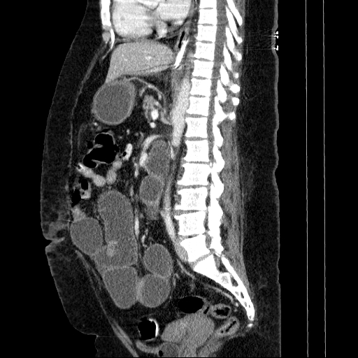 Afferent loop syndrome - secondary to incarcerated trocar site hernia (Radiopaedia 82959-97305 Sagittal C+ portal venous phase 73).jpg