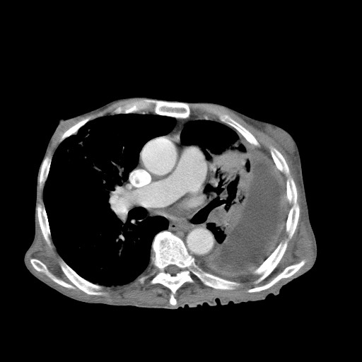 File:Aggressive lung cancer with cardiac metastases, pulmonary artery tumor thrombus, and Budd-Chiari (Radiopaedia 60320-67981 A 28).jpg