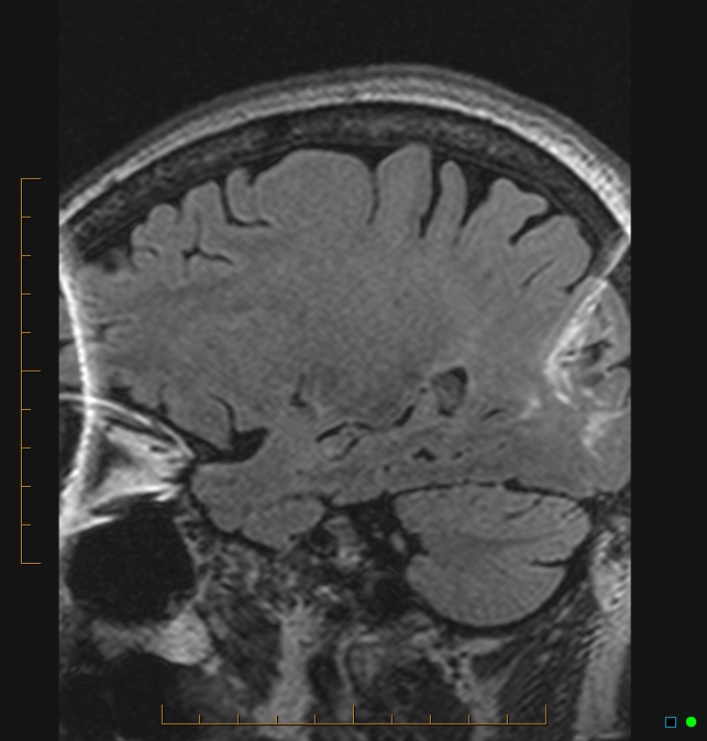 Aliasing artifact causing a spurious cerebellar lesion (Radiopaedia 48783-53810 Sagittal FLAIR 89).jpg