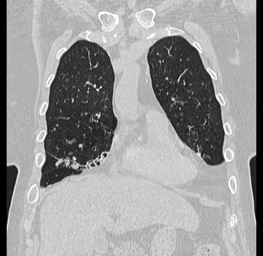 Alpha-1-antitrypsin deficiency (Radiopaedia 72058-82557 Coronal lung window 13).jpg