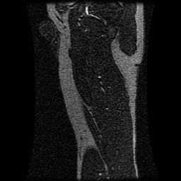 Alveolar soft part sarcoma (Radiopaedia 64501-73678 D 36).jpg