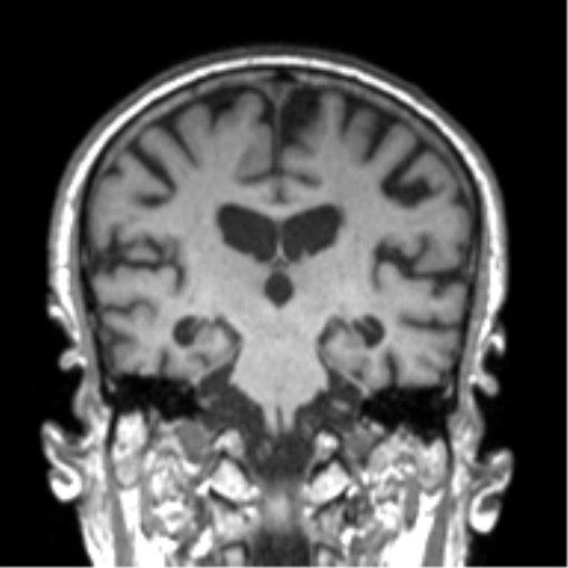 Alzheimer disease and cerebral amyloid angiopathy (Radiopaedia 64234-73011 Coronal T1 28).png