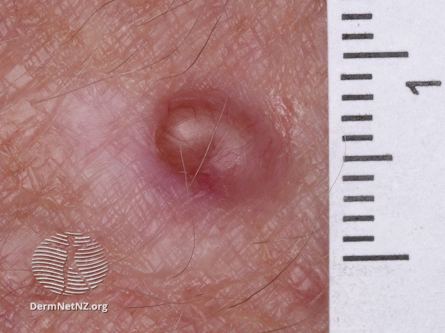 File:Amelanotic melanoma macro (DermNet NZ amelanotic-melanoma-034).jpg