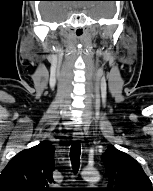 Ameloblastoma (Radiopaedia 38520-40623 Coronal non-contrast 42).png