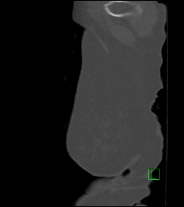 Amiodarone deposition in the liver (Radiopaedia 77587-89780 Sagittal bone window 2).jpg