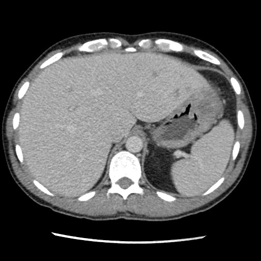 Amoebic liver abscesses (Radiopaedia 55536-62009 A 20).jpg