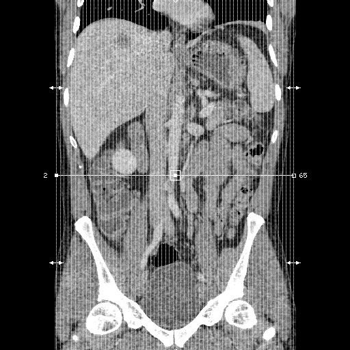 Amoebic liver abscesses (Radiopaedia 55536-62009 C 1).jpg