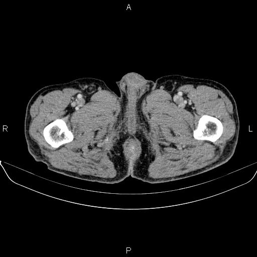 Ampullary adenocarcinoma (Radiopaedia 86093-102032 A 63).jpg