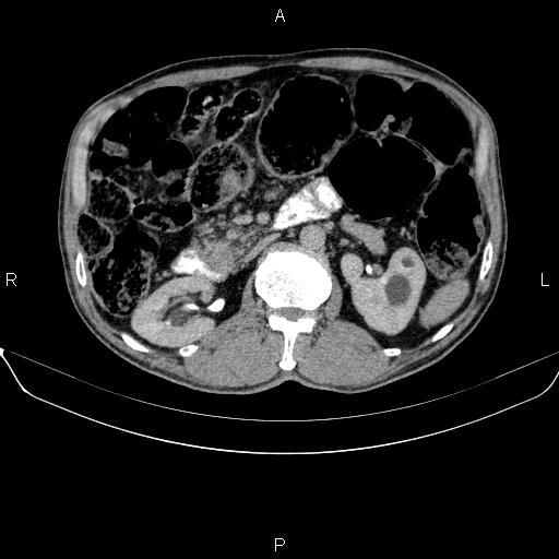 Ampullary adenocarcinoma (Radiopaedia 86093-102032 Axial C+ delayed 42).jpg