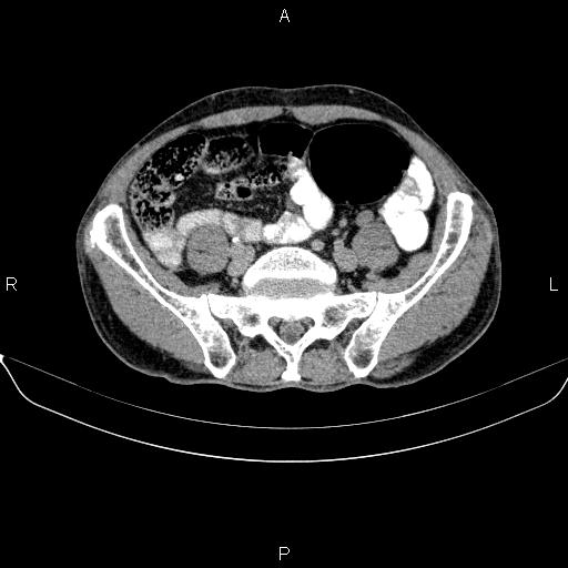 Ampullary adenocarcinoma (Radiopaedia 86093-102032 Axial C+ delayed 77).jpg