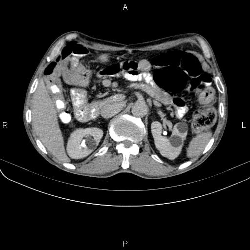 Ampullary adenocarcinoma (Radiopaedia 86093-102033 Axial C+ delayed 41).jpg