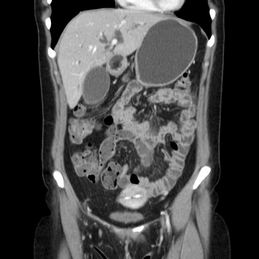 Ampullary tumor (Radiopaedia 22787-22816 E 19).jpg