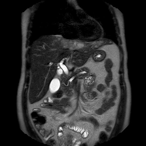 File:Ampullary tumor (Radiopaedia 27294-27479 Coronal T2 9).jpg