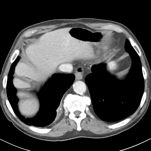 File:Amyand hernia (Radiopaedia 39300-41547 A 6).png