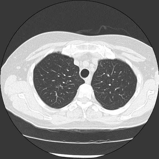 Amyloidosis - bronchial and diffuse nodular pulmonary involvement (Radiopaedia 60156-67744 B 14).jpg