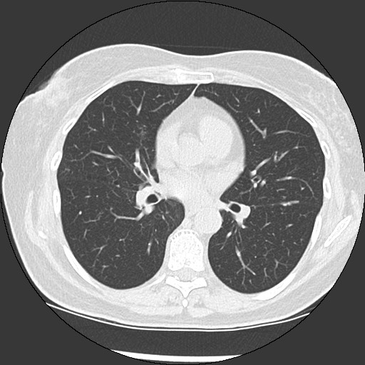 Amyloidosis - bronchial and diffuse nodular pulmonary involvement (Radiopaedia 60156-67744 B 30).jpg