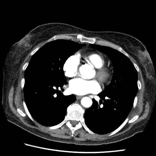 Amyloidosis - bronchial and diffuse nodular pulmonary involvement (Radiopaedia 60156-67745 A 31).jpg