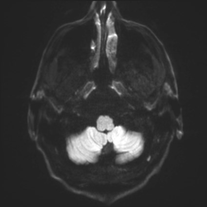 Amyotrophic lateral sclerosis (Radiopaedia 87352-103658 Axial DWI 30).jpg