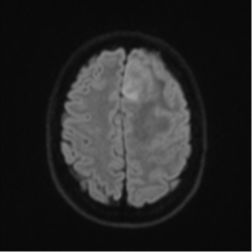 File:Anaplastic astrocytoma (Radiopaedia 57768-64731 Axial DWI 50).png