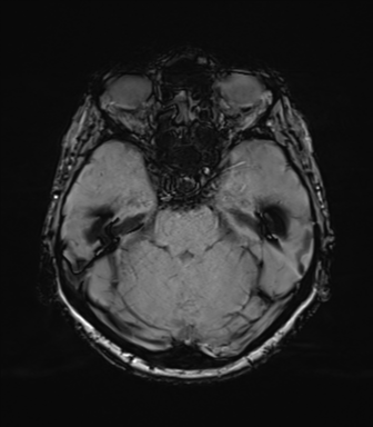 Anaplastic astrocytoma (Radiopaedia 86943-103160 Axial SWI 32).png