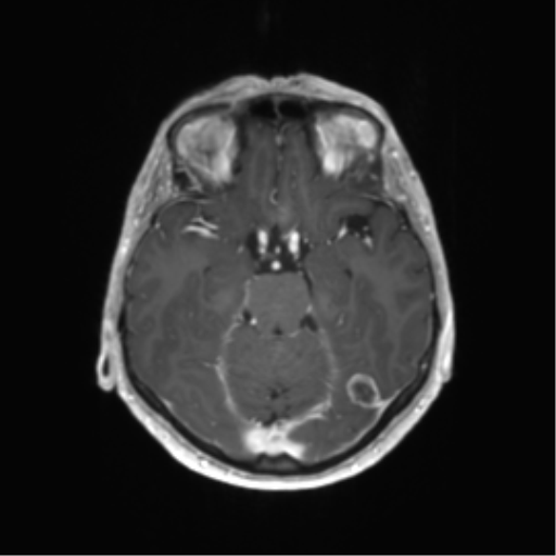 File:Anaplastic astrocytoma (Radiopaedia 86943-103160 Axial T1 C+ 9).png
