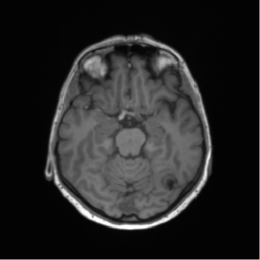 Anaplastic astrocytoma (Radiopaedia 86943-103160 Coronal T1 11).png
