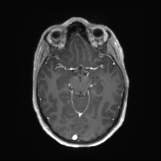 File:Anaplastic astrocytoma IDH mutant (Radiopaedia 50046-55341 Axial T1 C+ 21).png