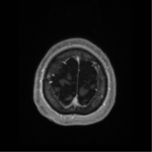 File:Anaplastic astrocytoma IDH wild-type (pseudoprogression) (Radiopaedia 42209-45276 Axial T1 C+ 135).png