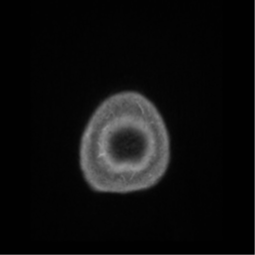 Anaplastic astrocytoma IDH wild-type (pseudoprogression) (Radiopaedia 42209-45276 Axial T1 C+ 148).png
