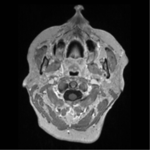 Anaplastic astrocytoma IDH wild-type (pseudoprogression) (Radiopaedia 42209-45276 Axial T1 C+ 4).png