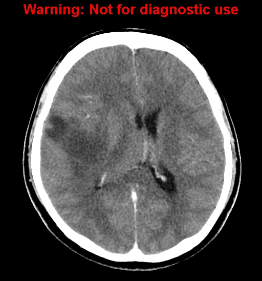 File:Anaplastic ganglioglioma (Radiopaedia 44921-48815 B 17).jpg