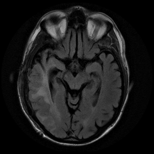 File:Anaplastic meningioma with recurrence (Radiopaedia 34452-35791 Axial FLAIR 9).png