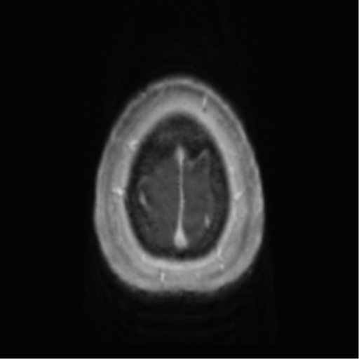Anaplastic oligodendroglioma (Radiopaedia 83500-98599 Axial T1 C+ 72).png