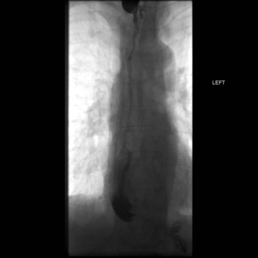 File:Anastomotic stricture post Ivor Lewis esophagectomy (Radiopaedia 47937-52715 B 45).png