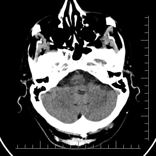 Aneurysm of posterior communicating artery (Radiopaedia 20188-20162 Axial non-contrast 10).jpg