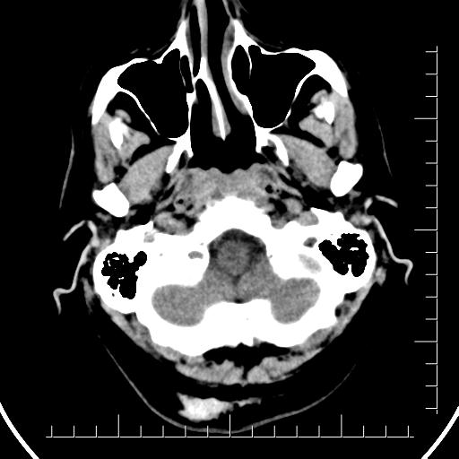 Aneurysm of posterior communicating artery (Radiopaedia 20188-20162 Axial non-contrast 5).jpg
