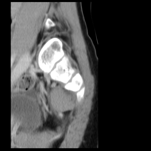 File:Aneurysmal bone cyst - sacrum (Radiopaedia 65190-74195 A 5).jpg
