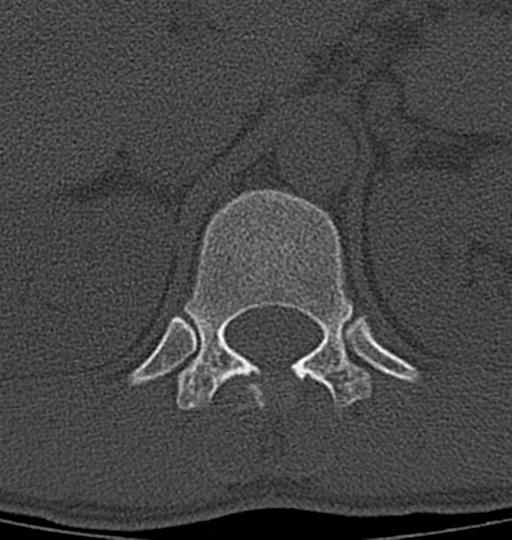 Aneurysmal bone cyst T11 (Radiopaedia 29294-29721 Axial bone window 52).jpg