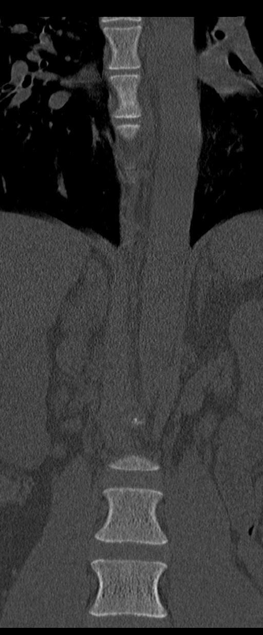 Aneurysmal bone cyst T11 (Radiopaedia 29294-29721 Coronal bone window 13).jpg