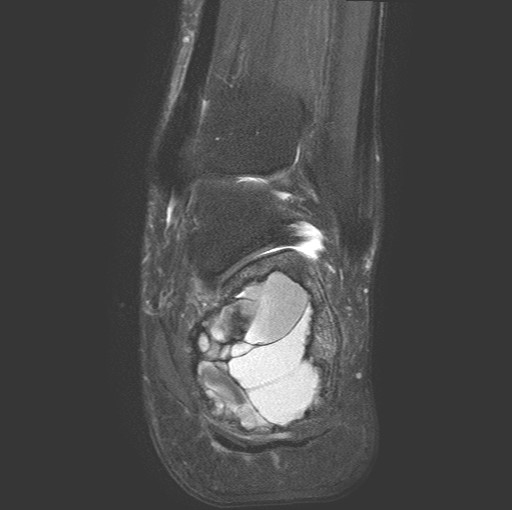 File:Aneurysmal bone cyst of the calcaneus (Radiopaedia 60669-68420 Coronal T2 fat sat 15).jpg