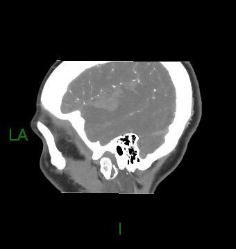File:Aneurysmal subarachnoid hemorrhage with intra-axial extension (Radiopaedia 84371-99732 B 59).jpg